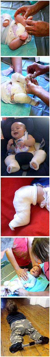 ponseti treatment for clubfoot